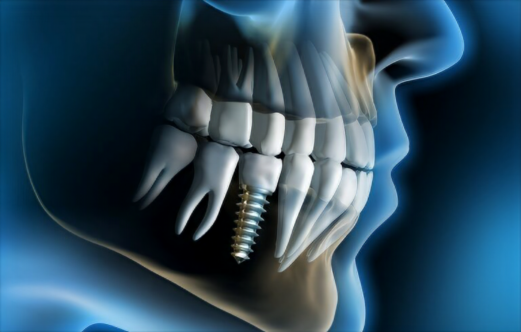 implante dentário não dói