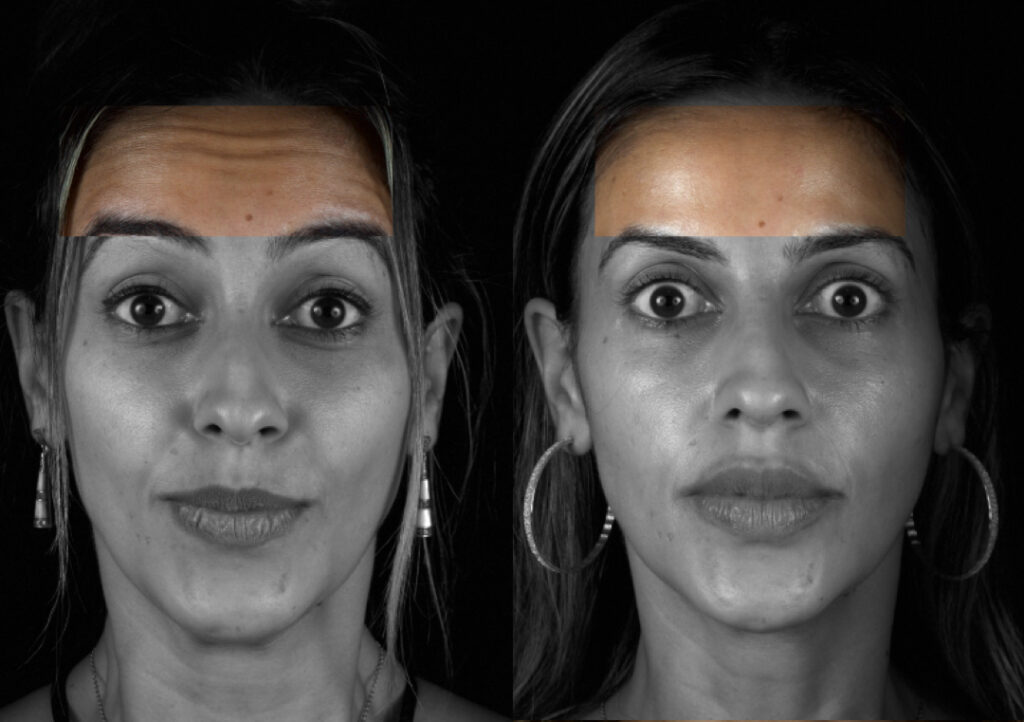 Aplicação de Botox para reduzir rugas