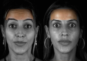 Aplicação de Botox para reduzir rugas