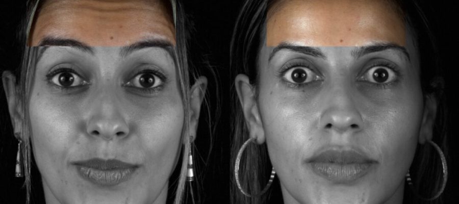 Aplicação de Botox para reduzir rugas