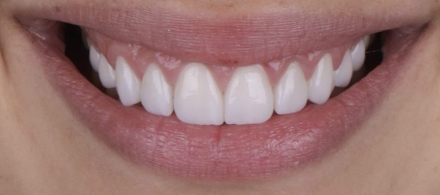 Lentes de contato dental .002